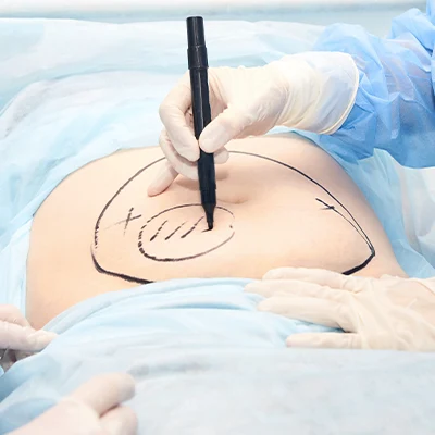 abdominoplastie