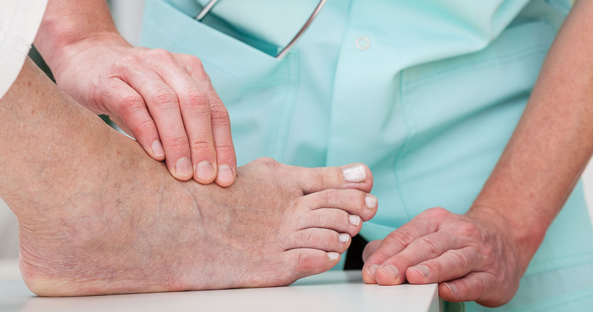 Prévenir l'Hallux Valgus